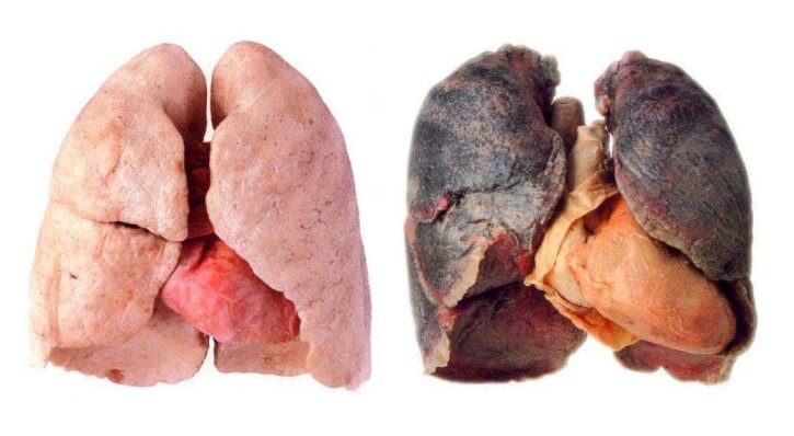 Smoker's lungs