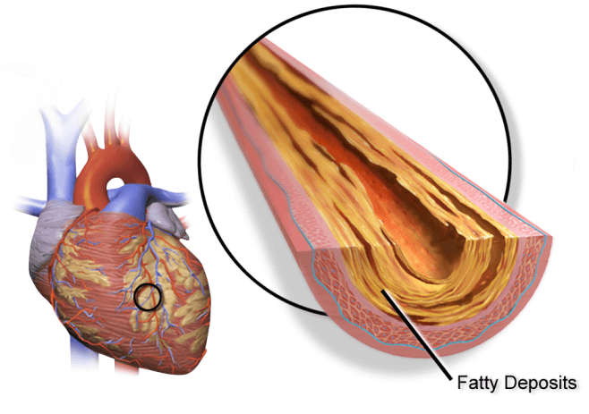 Atherosclerosis