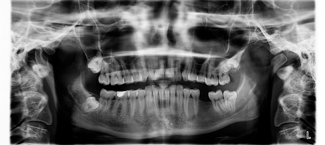 Human teeth